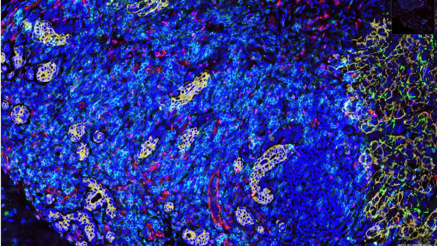 Tumor microenviroment